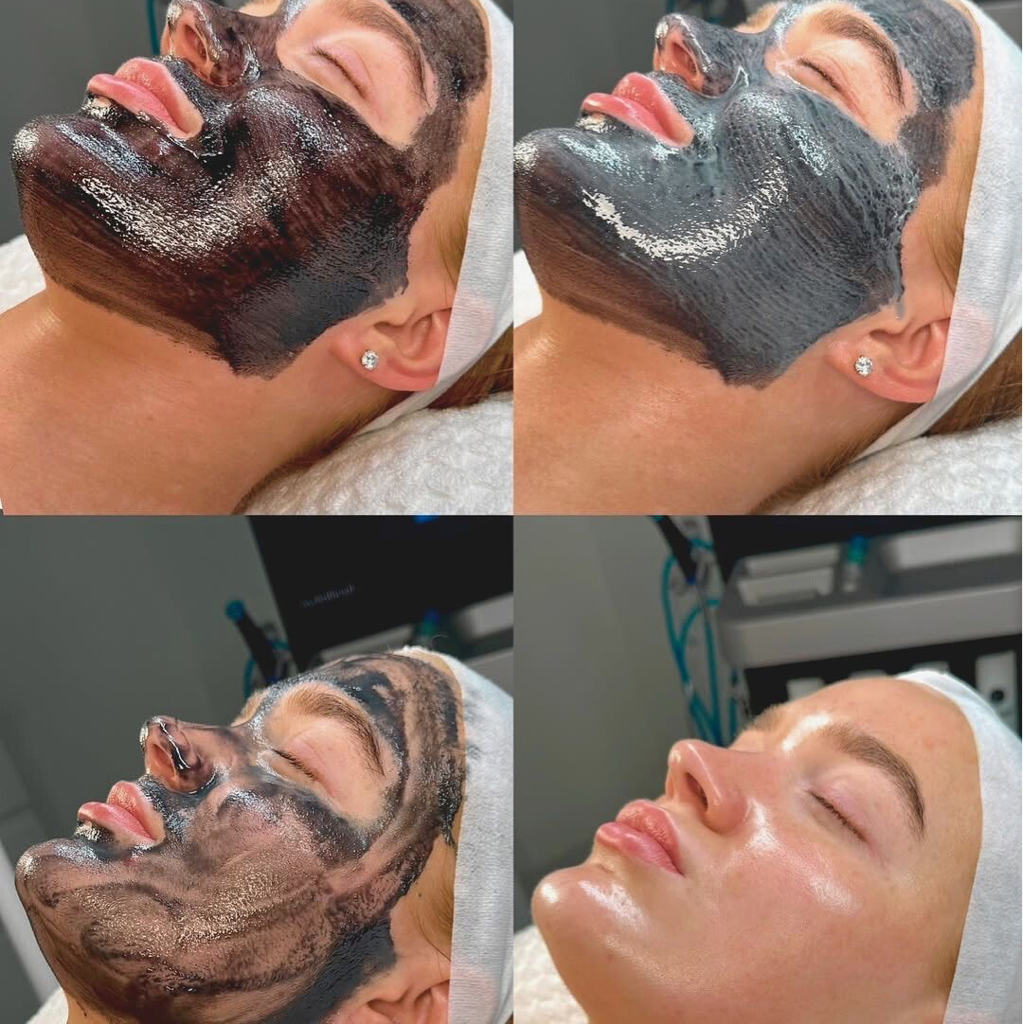 Карбоновый пилинг