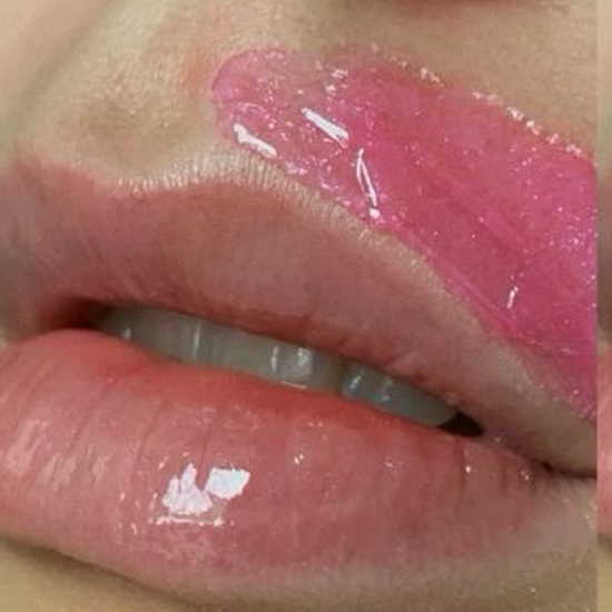 Удаление пушка над губой