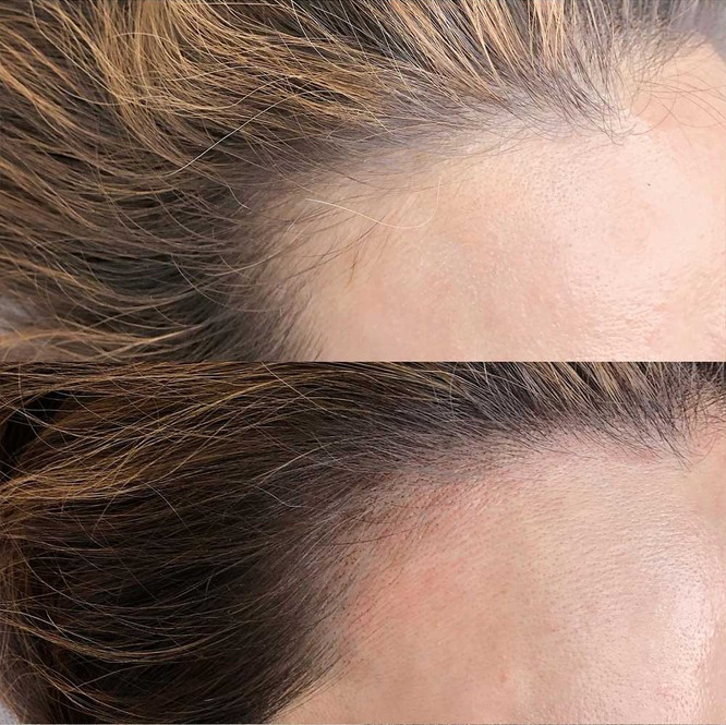 АКЦИЯ! Трихопигментация.Маскировка шрамов и залысин