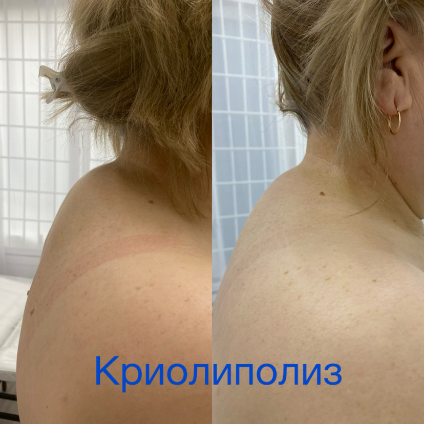 Криолиполиз тела 1 насадка
