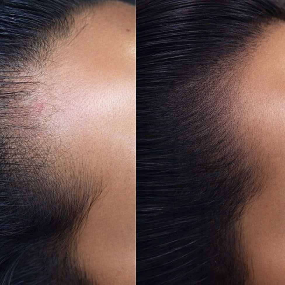 ТРИХОПИГМЕНТАЦИЯ SMP волос головы