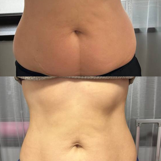 Антицеллюлитный массаж