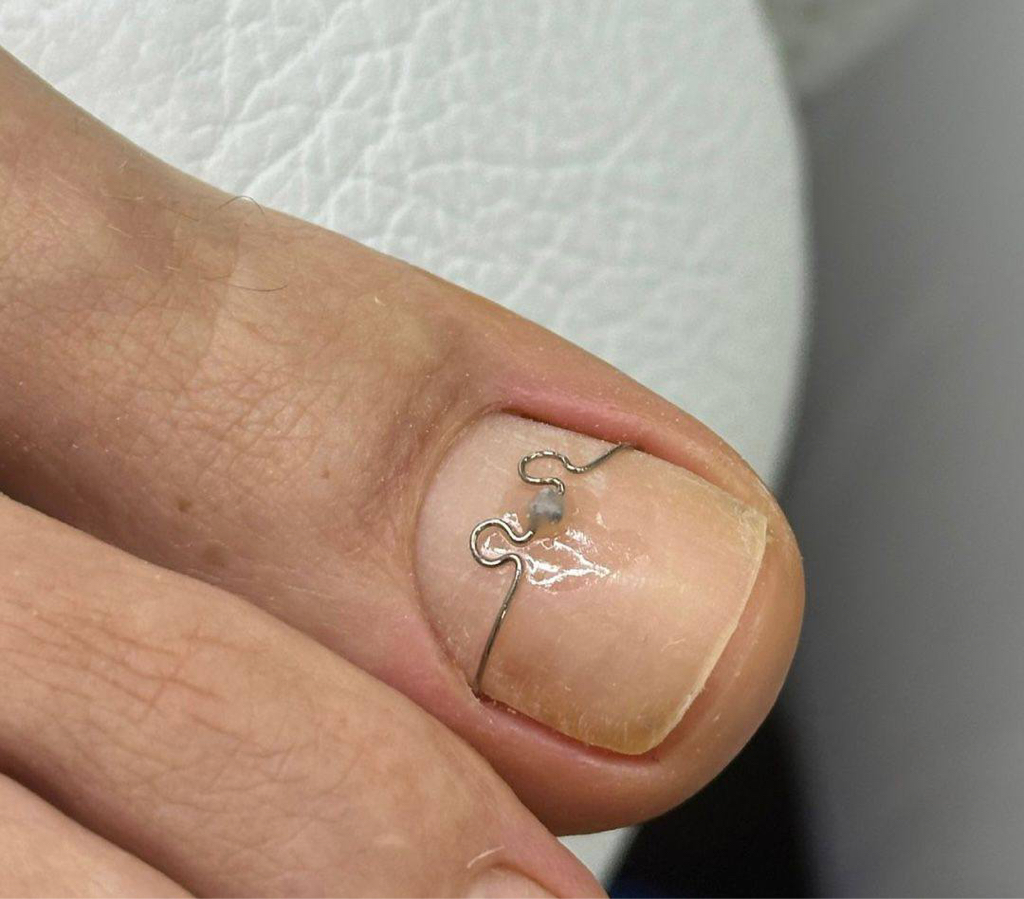 Косметическая Коррекция скобы Фрейзера