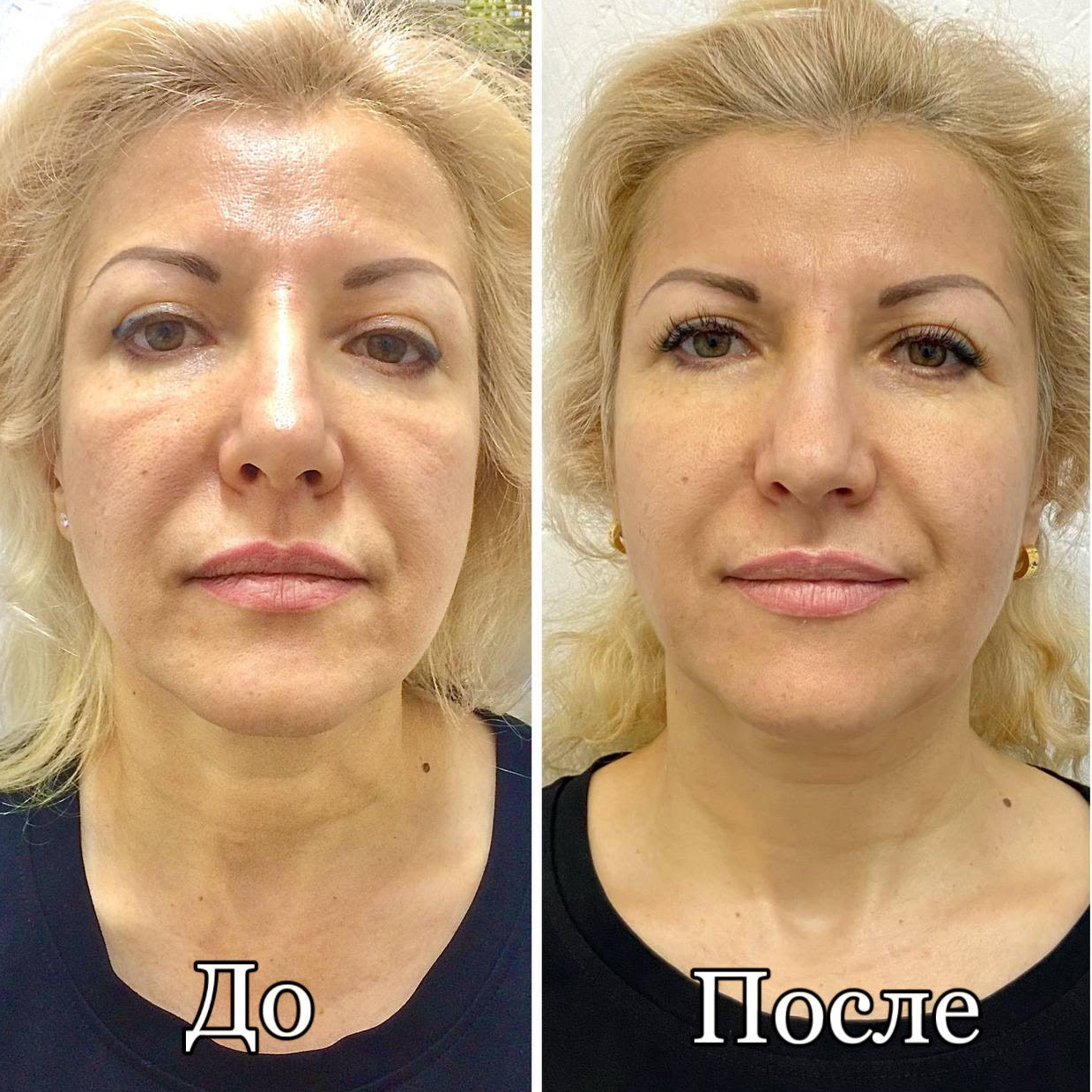 Витапластика с фото для соцсетей