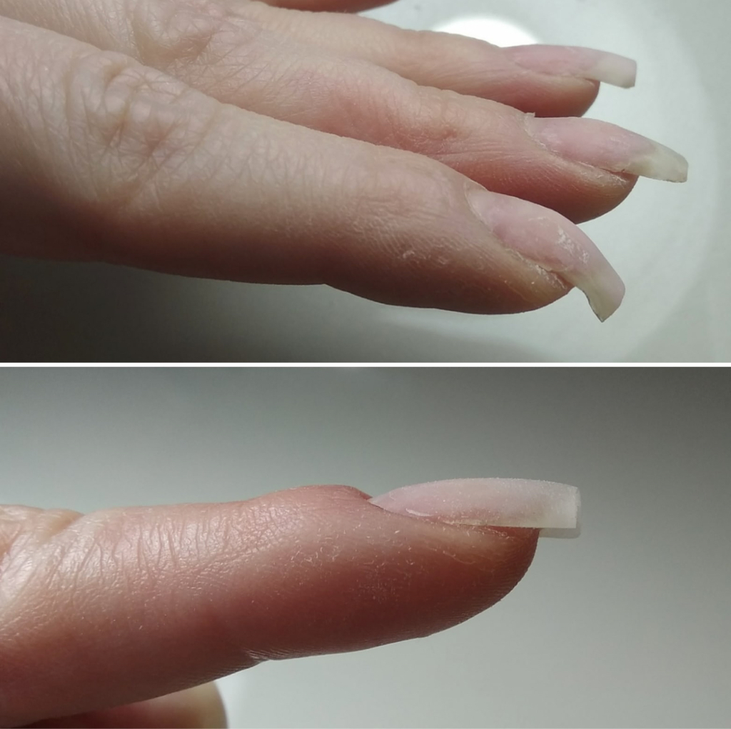 Исправление клюющего ногтя