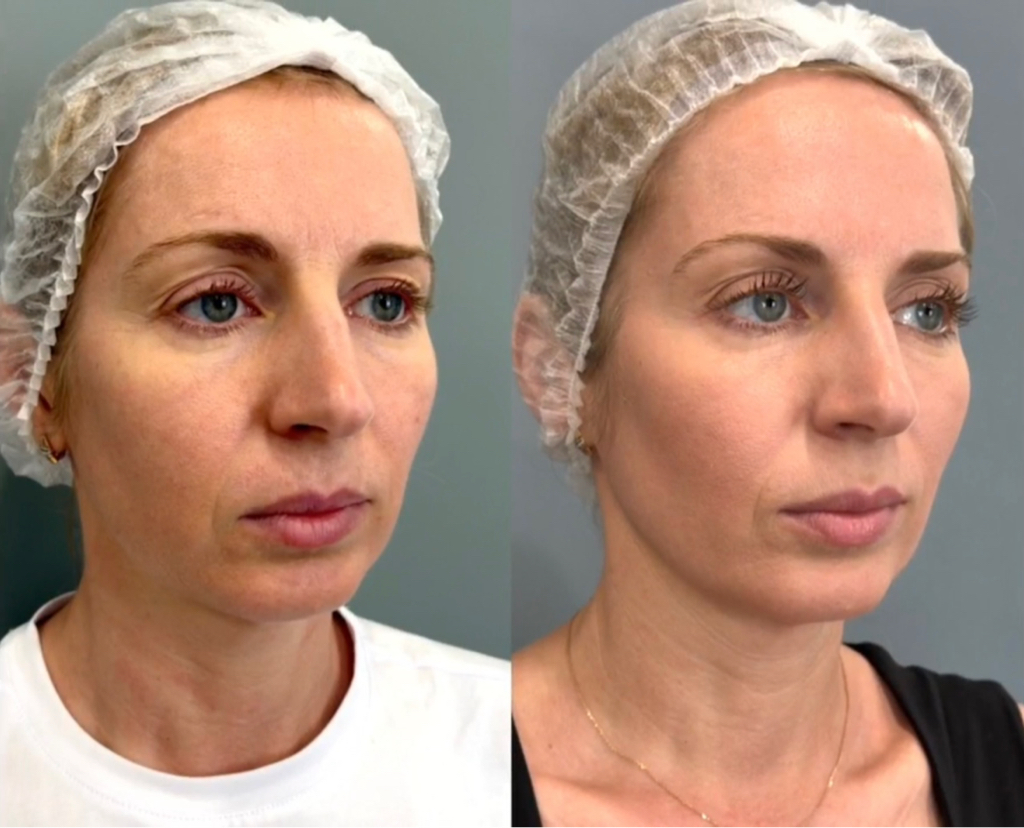 Ботокс full face and neck