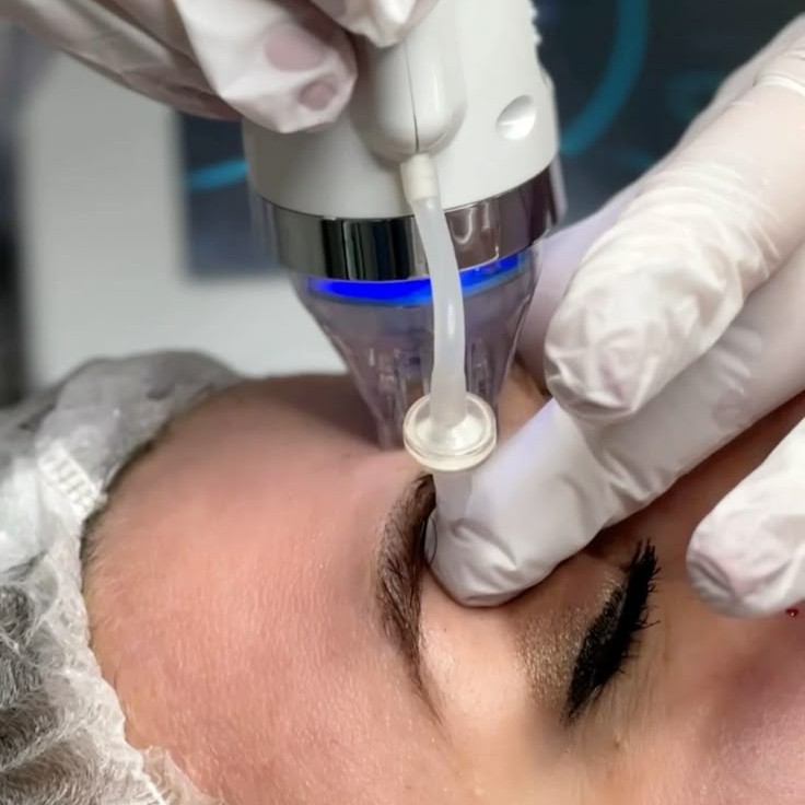 Микроигольчатый RF-лифтинг (лицо+шея+декольте)