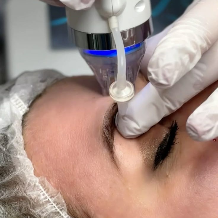 Микроигольчатый RF-лифтинг (лицо)