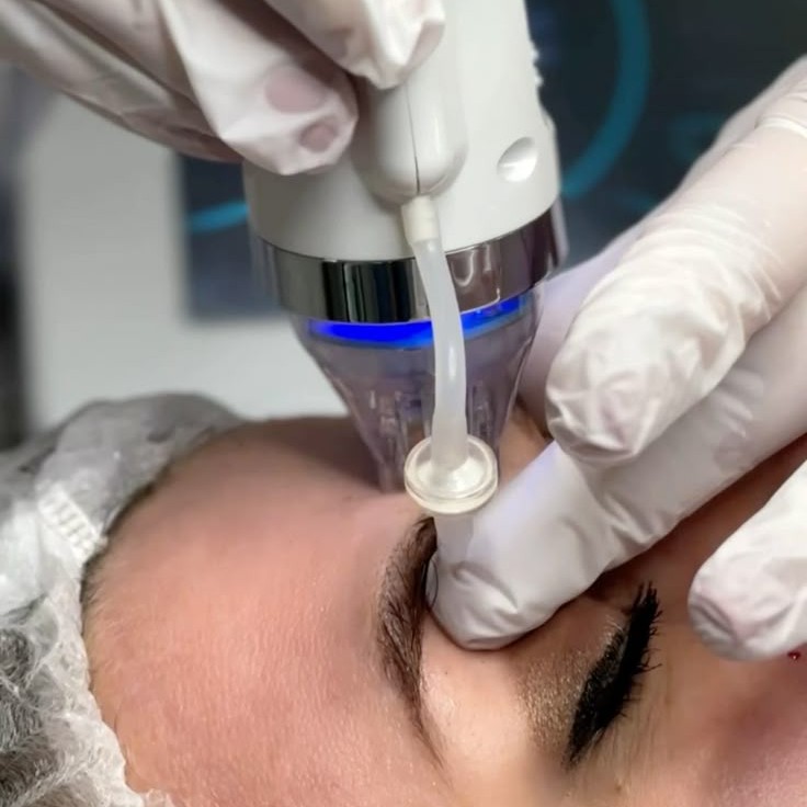 Микроигольчатый RF-лифтинг (лицо+шея)