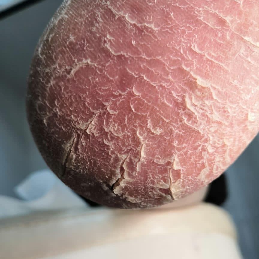 ПЕДИКЮР МЕДИЦИНСКИЙ