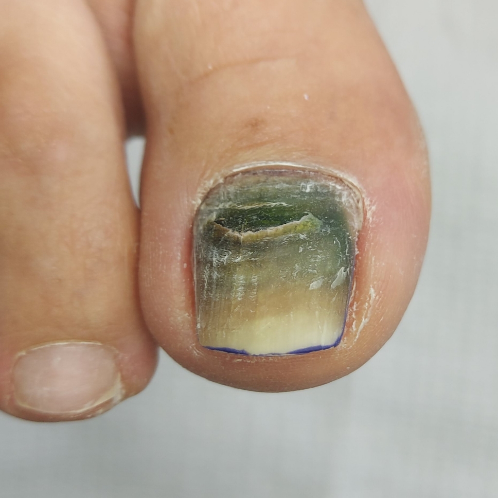 Удаление вросшего ногтя, бородавок, мозолей, зачистка грибковой инфекции, подстригание ногтей