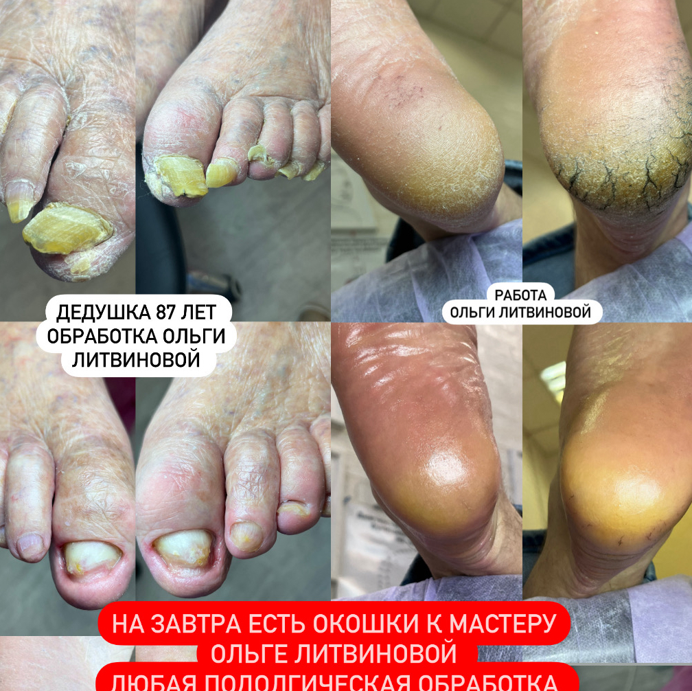 До конца АПРЕЛЯ.Подологический педикюр любой сложности.