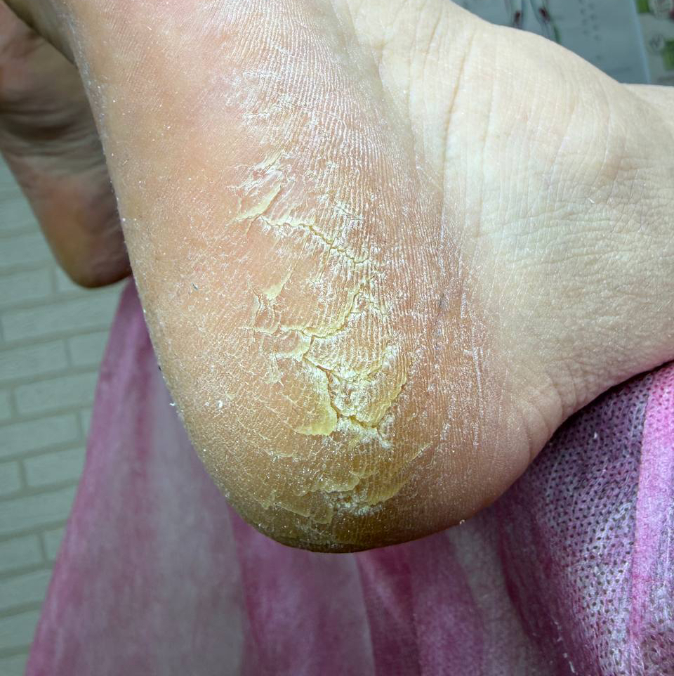 Консультация + обработка стоп (трещины,гиперкератоз)