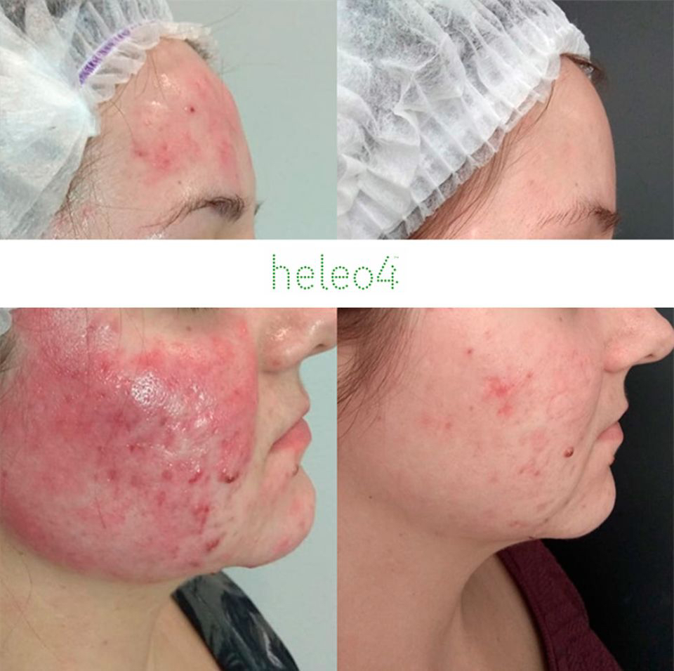 Акция Гелео4  Розацея