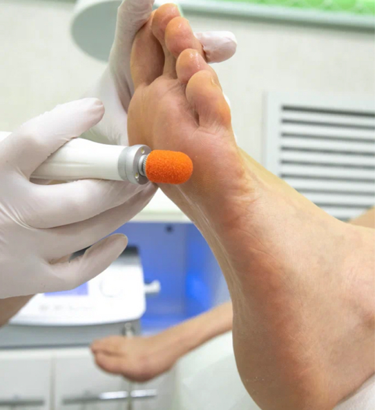 Аппаратная подологическая обработка стопы 
ТОП-МАСТЕР