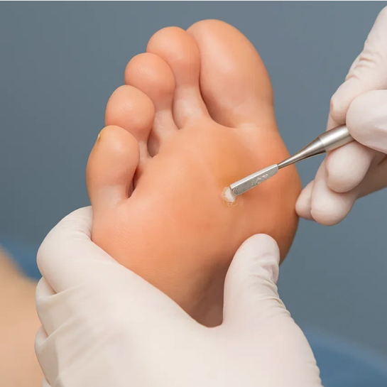 Стержневая мозоль 
ТОП-МАСТЕР