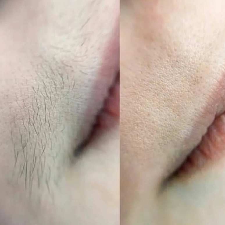 депиляция лица