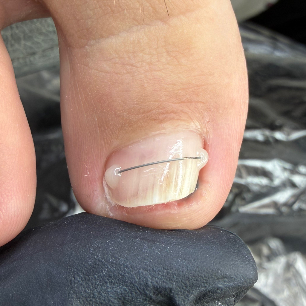 Установка титановой нити (2 шт.)