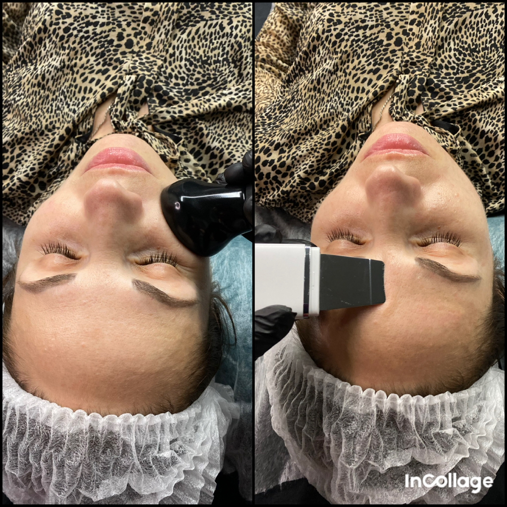 Ультразвуковая чистка лица ( УЗ чистка лица)