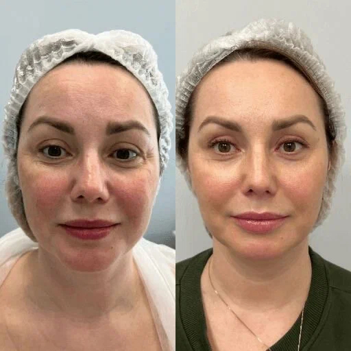 Курс на омолаживающий комплекс для лица на 10 процедур