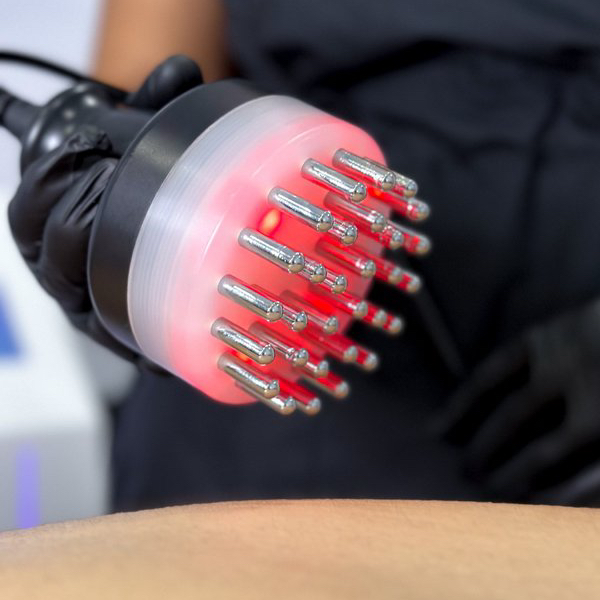 Rf лифтинг 2-3 зоны  (50 мин)