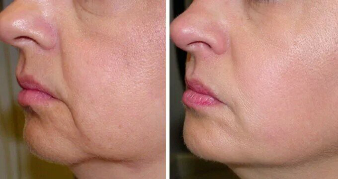 Курс Rf лифтинг Абонемент на 5 процедур  (30мин)