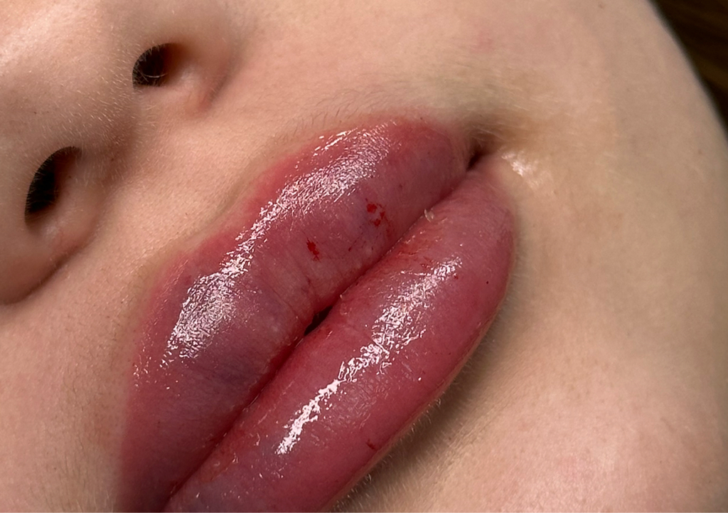 Контурная пластика губ