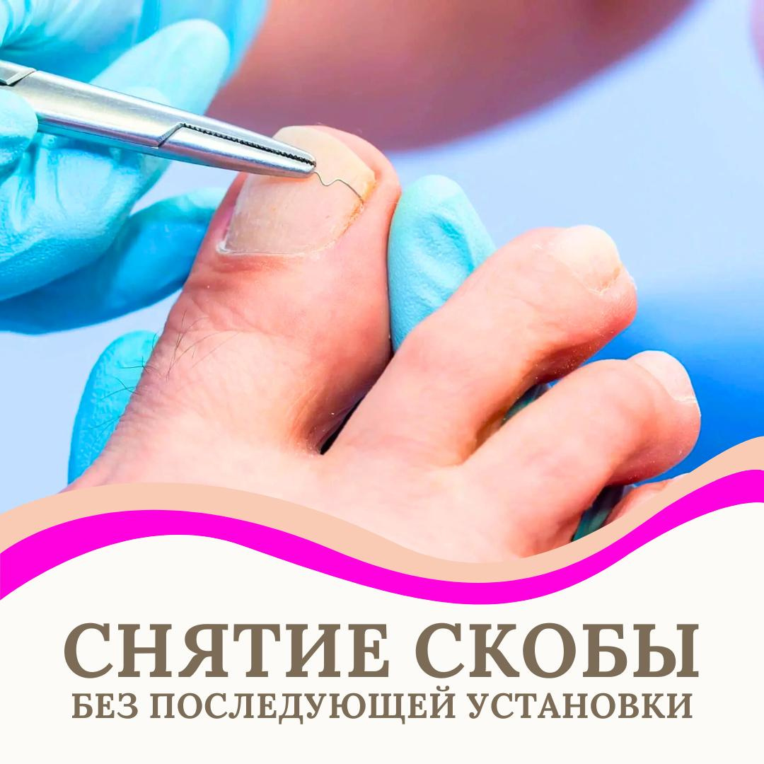 Снятие скобы без последующей установки