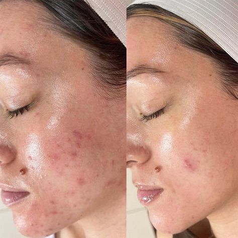 Уз чистка +пилинг Sebo BALANCE 2250 вместо 4500