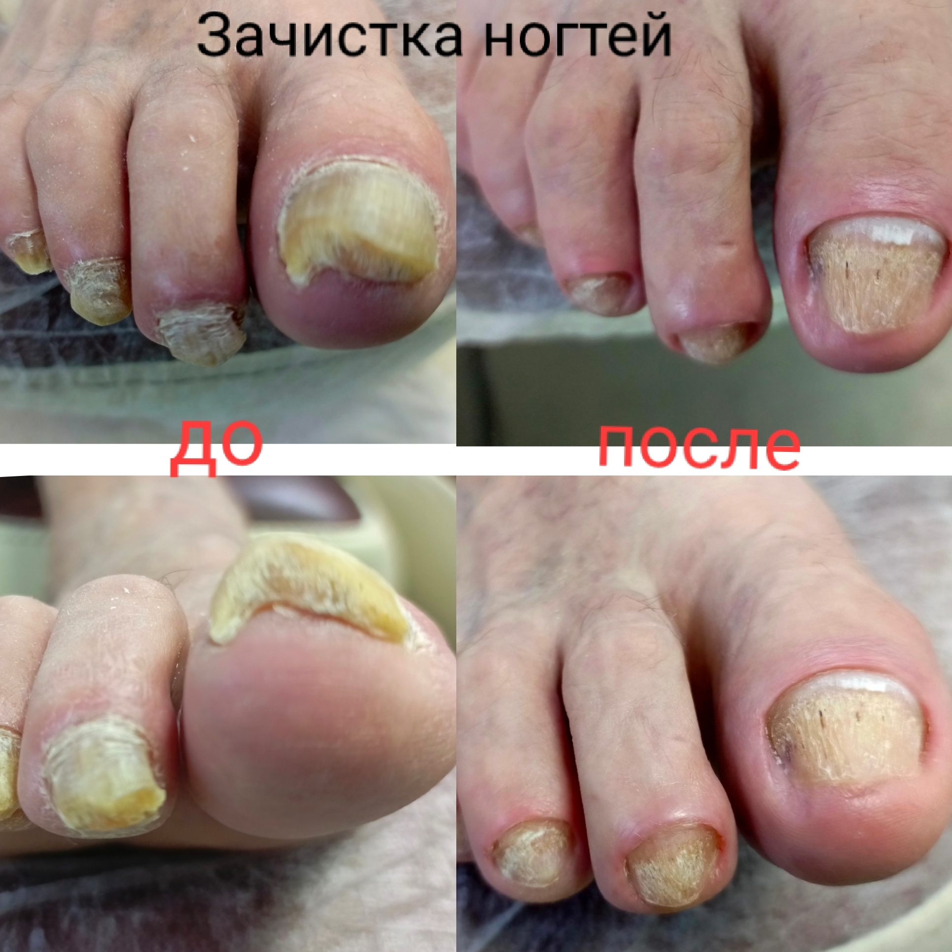 Педикюр мужской аппаратный Смарт проблемные ноги с гиперкератозом/онихомикозом (ПЕРВИЧНАЯ ОБРАБОТКА)