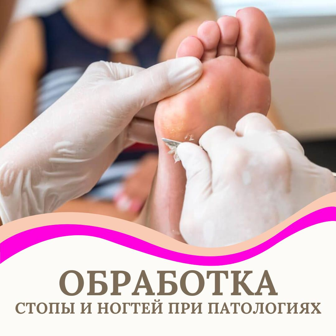 Обработка стопы и ногтей при патологиях (грибок, инфекция...)