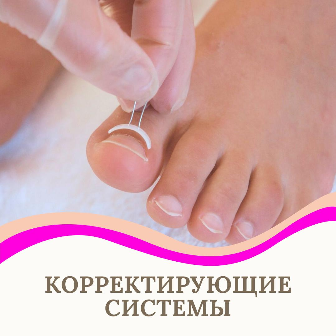 Титановая нить, Скоба Фрезера, Унибрейс, ЗТО