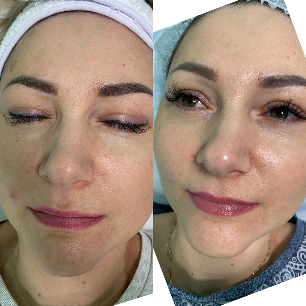 Биоревитализация лица