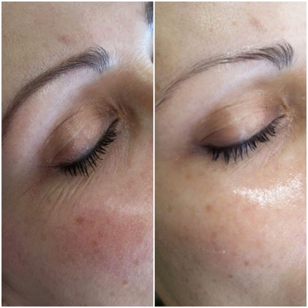 Биоревитализация зоны вокруг глаз