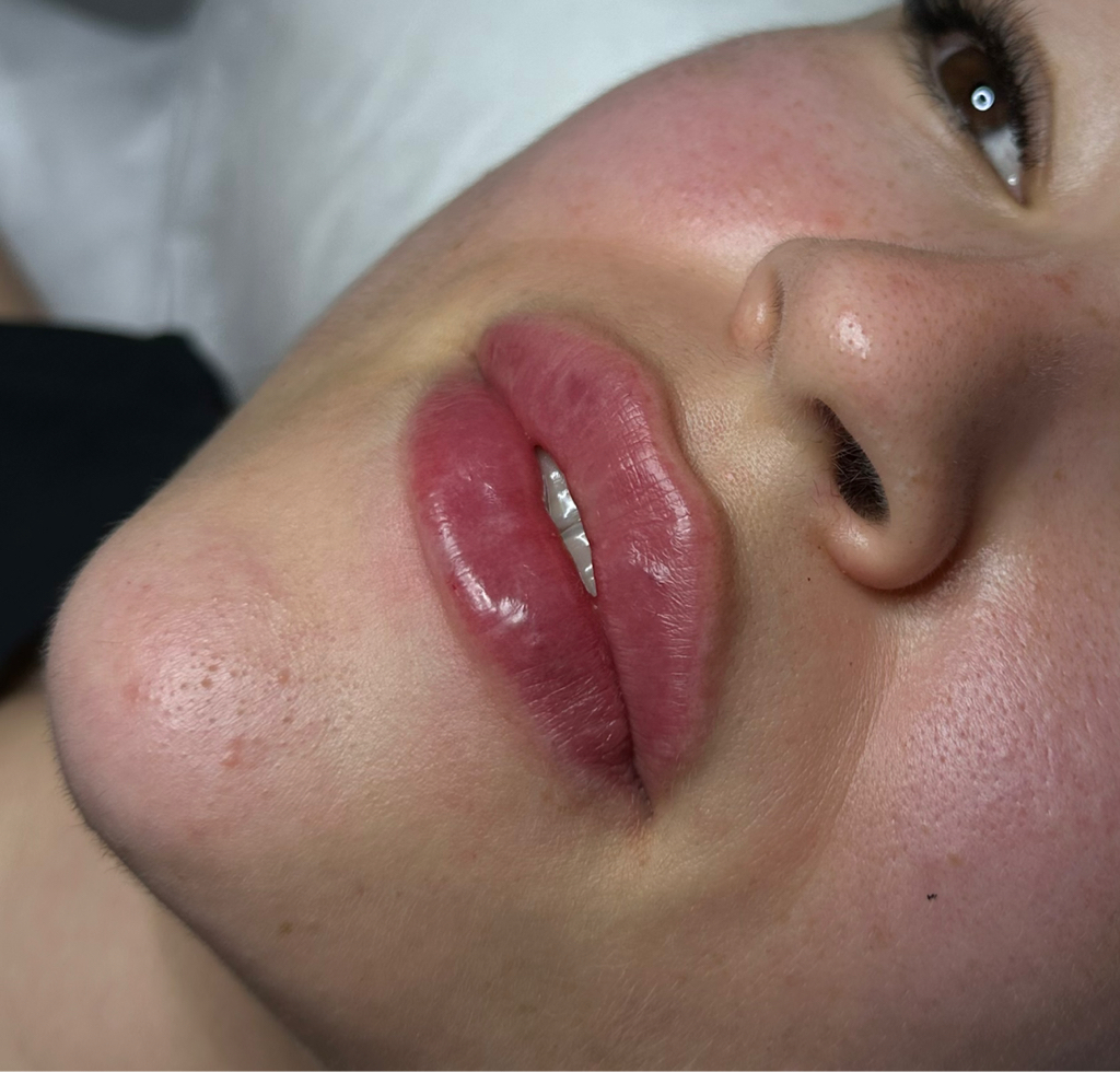 Elasty 1ml