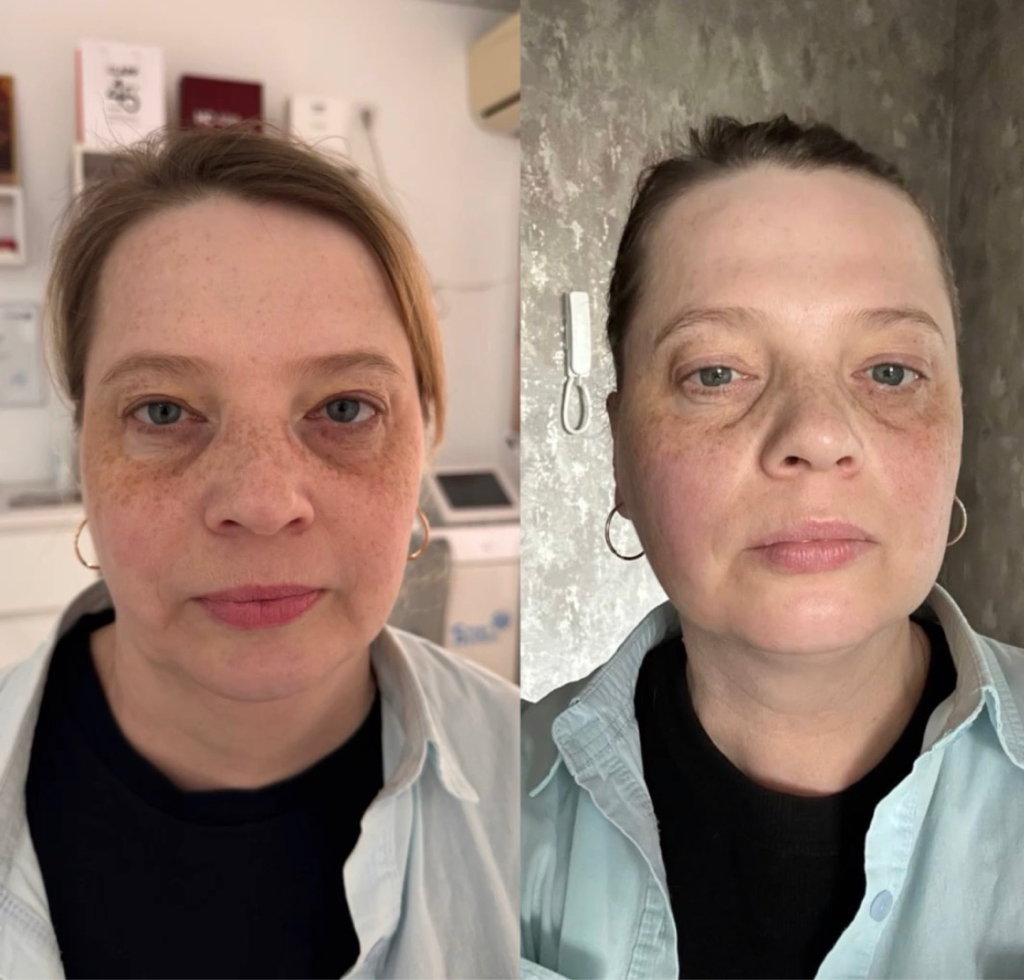 DMAE Peel  Всесезонный пилинг биоревитализант с высоким % ДМАЭ