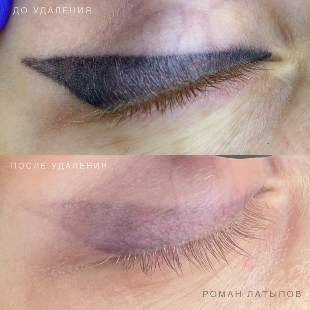 Удаление стрелочек премиум лазером