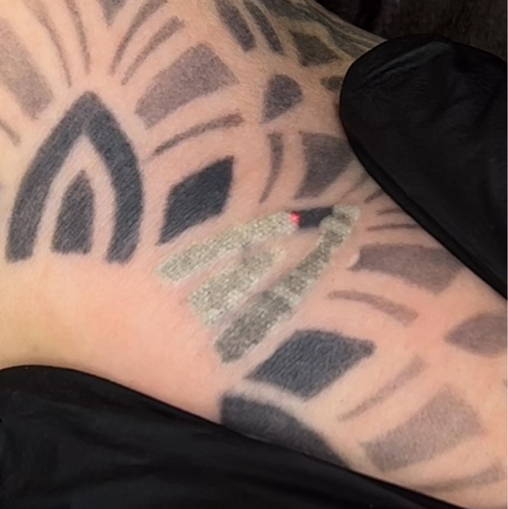 Лазерное удаление татуировки