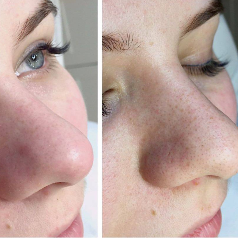 Нетравматичная комплексная чистка лица с применением обновляющего пилинга