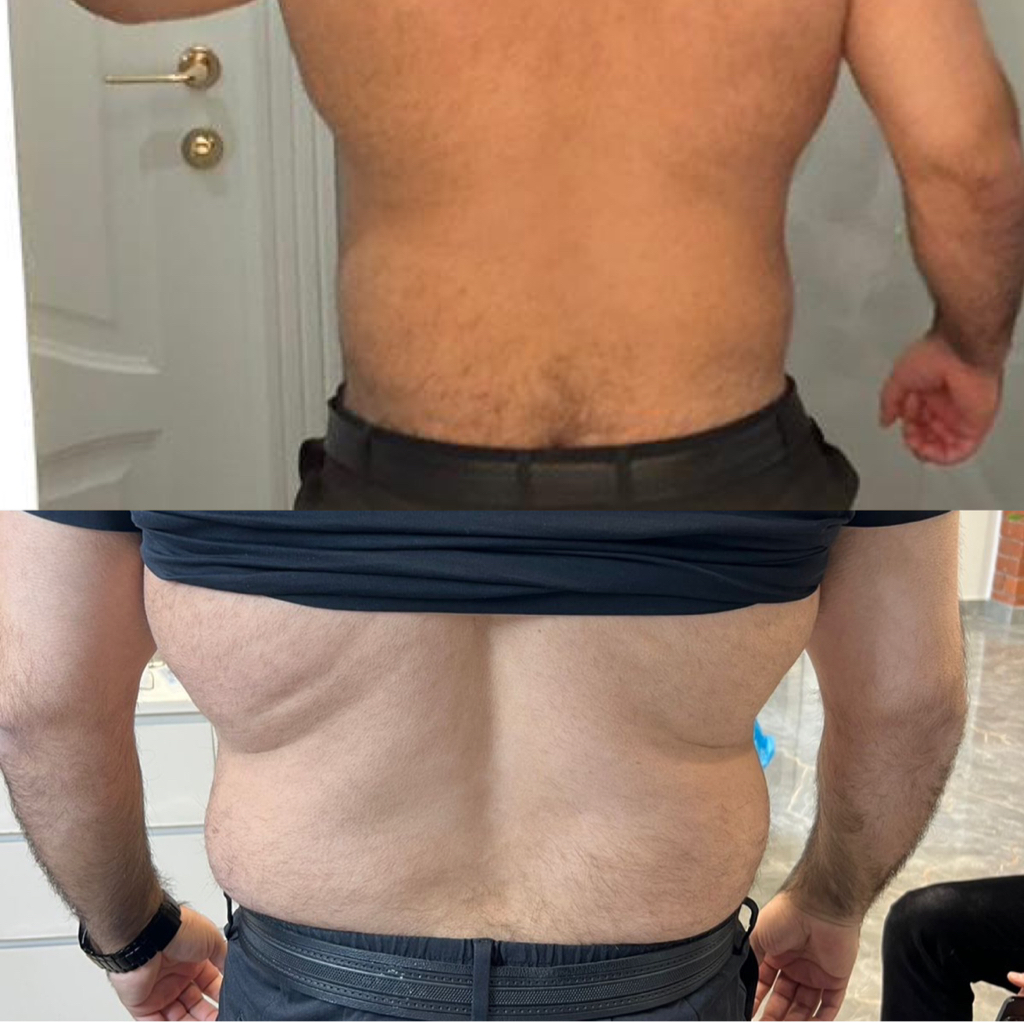 Липолитик  СТРОЙНОСТЬ 1+1+1 =6 мл