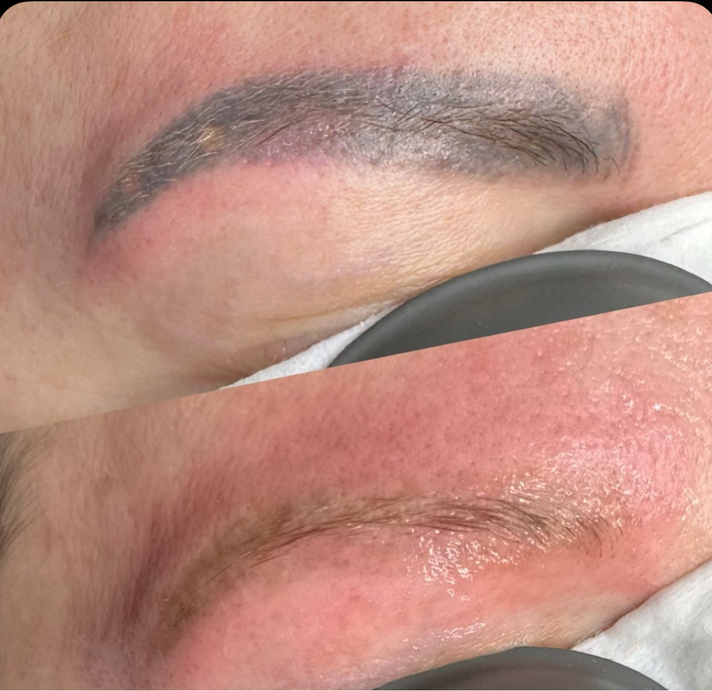 Удаление лазером брови