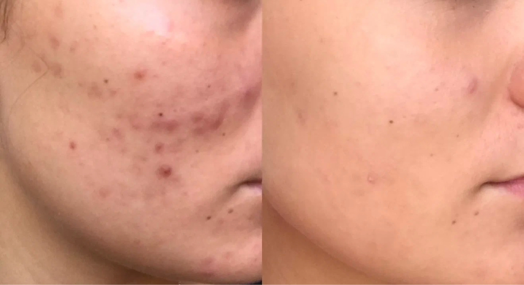 Фотоомоложение / Фототерапия IPL : Спина полностью