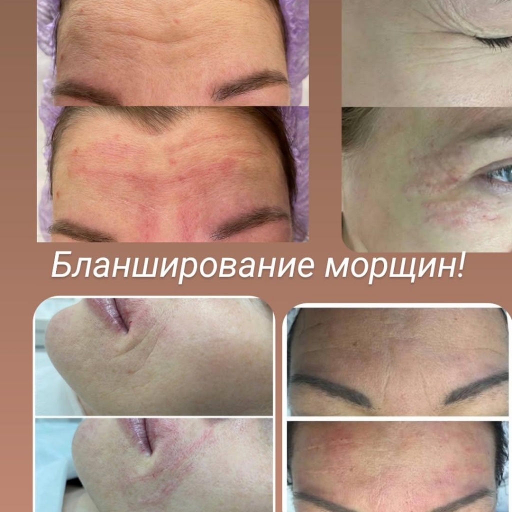 Бланширование морщин