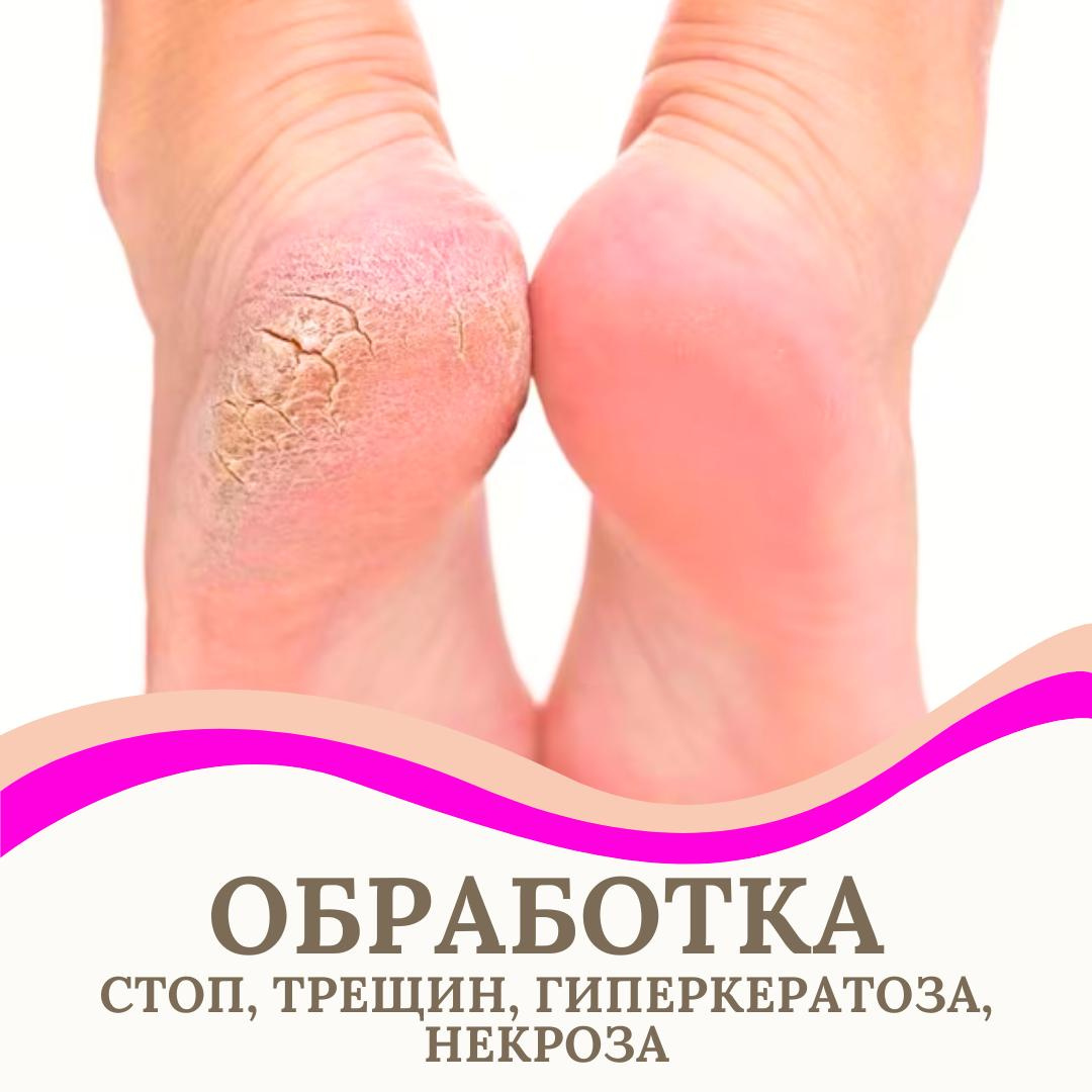 обработка стоп, обработка трещин, гиперкератоза, микоза
