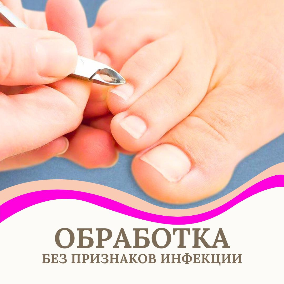 обработка ногтей без признаков инфекции