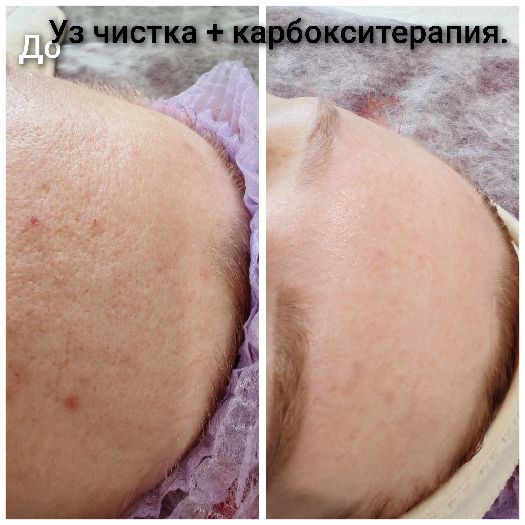 Уз чистка + карбокситерапия ( пилинг) + маска