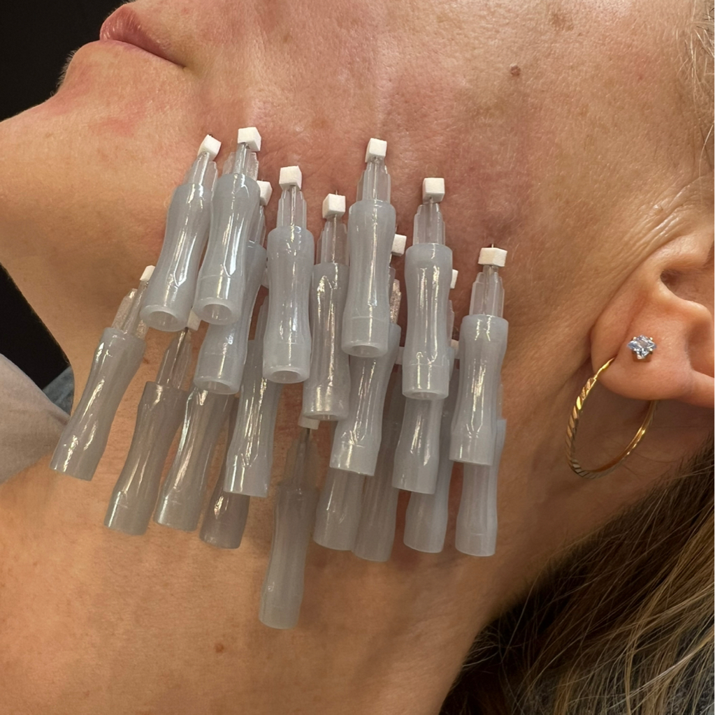 Мезонити plla 40 шт