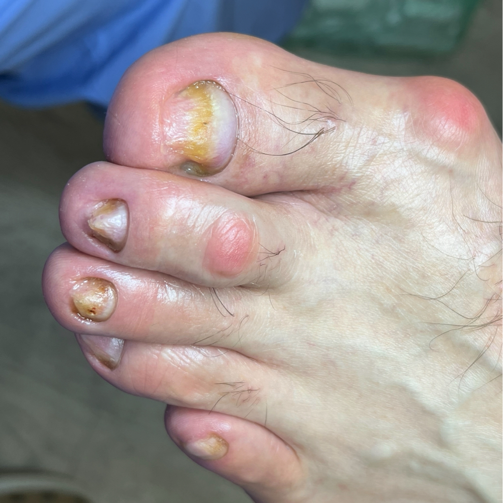 Выезд на дом. Подологическая обработка.