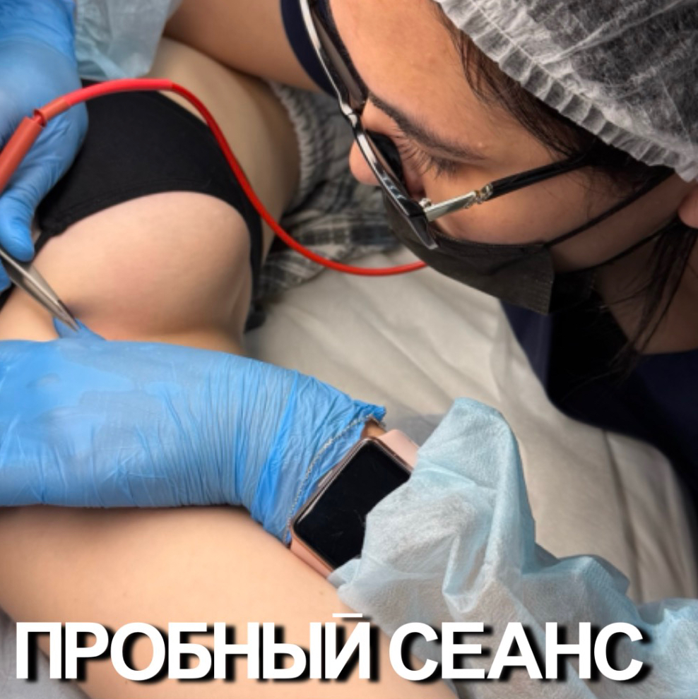 Пробный сеанс электроэпиляции любой зоны