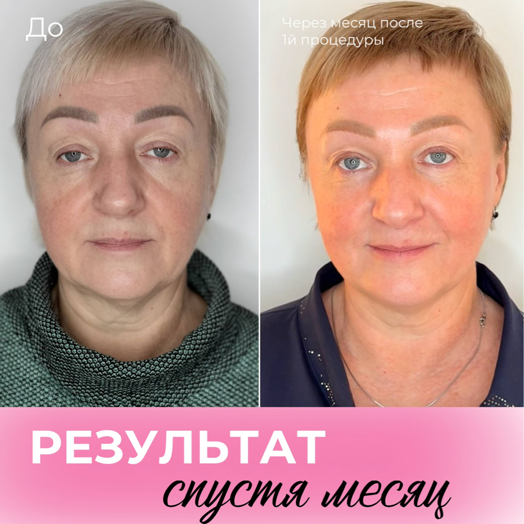 Микроигольчатый RF-лифтинг лица, шеи и декольте — комплексное омоложение